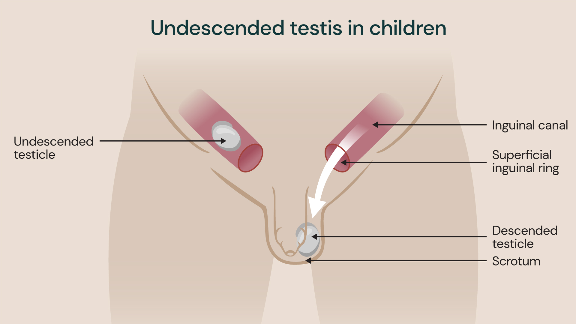 Undescended testis in children