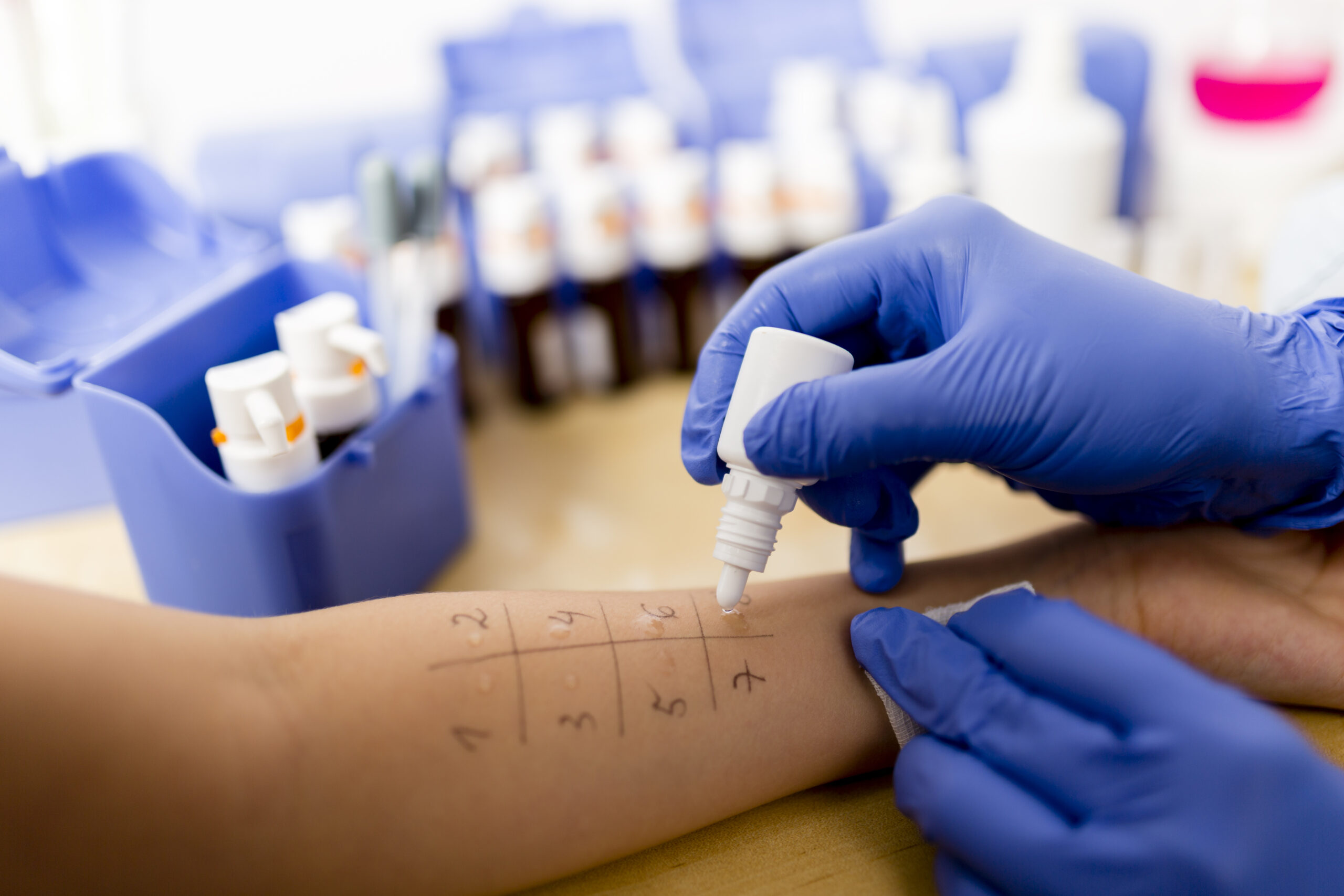 Skin prick allergy test being performed
