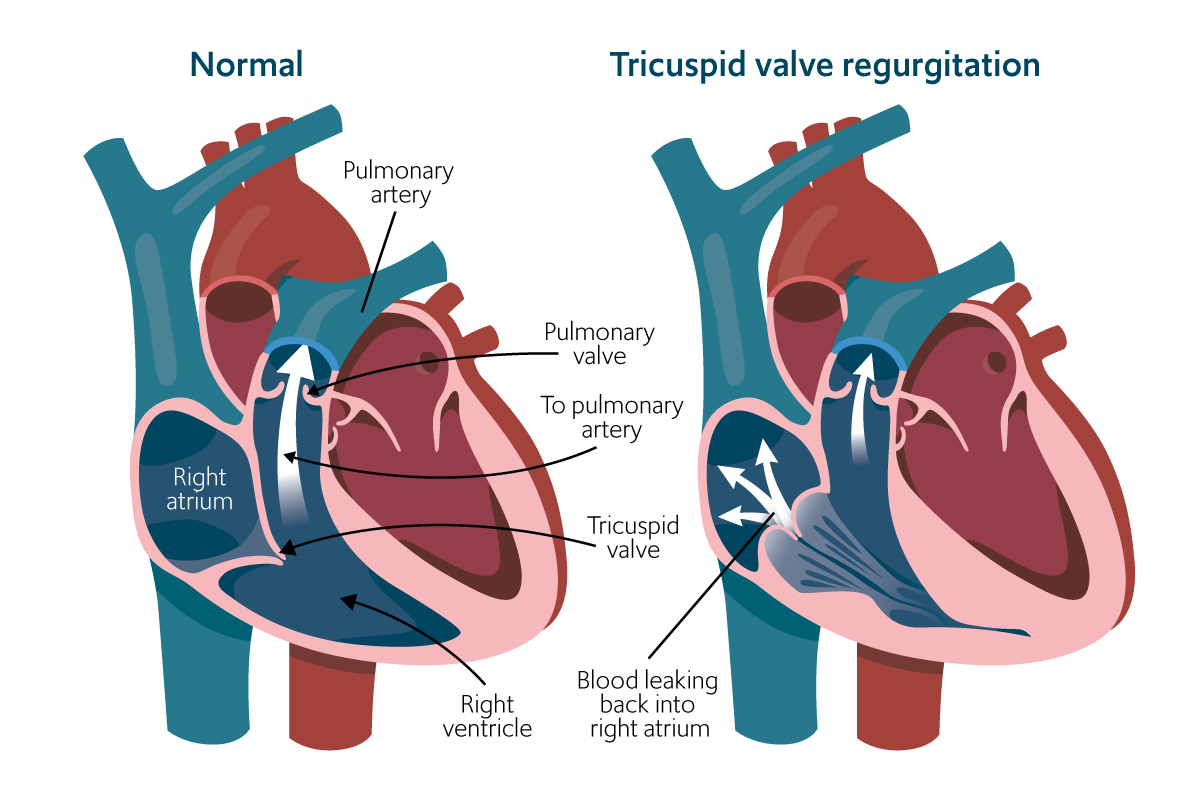 Diagram showing the difference between normal heart and tricuspid valve regurgitation