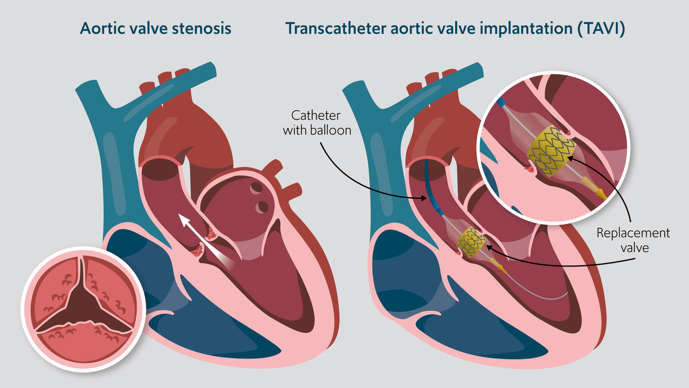 Aortic valve stenosis and Transcatheter aortic valve implantation (TAVI)