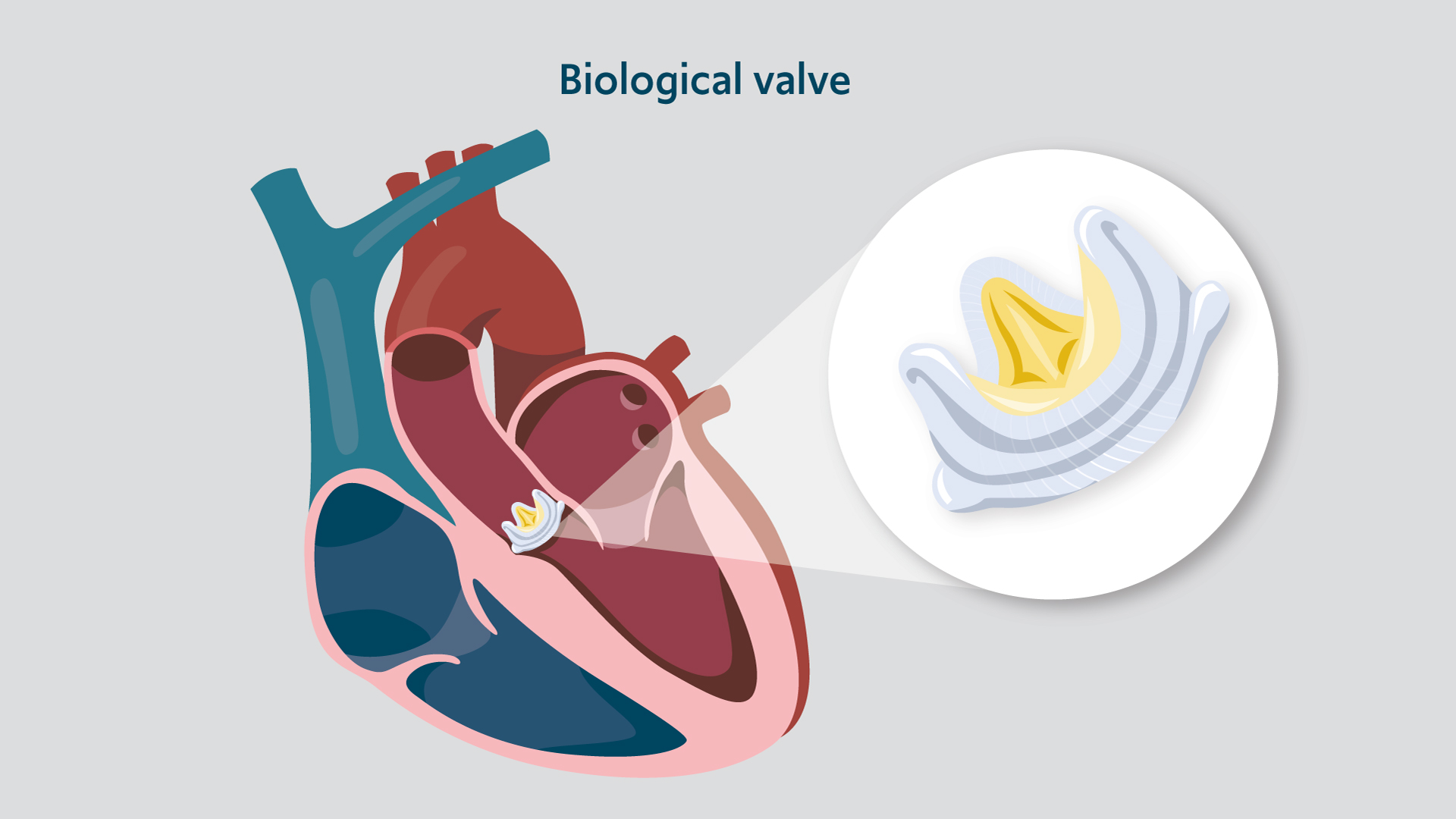 Illustration of a biological valve