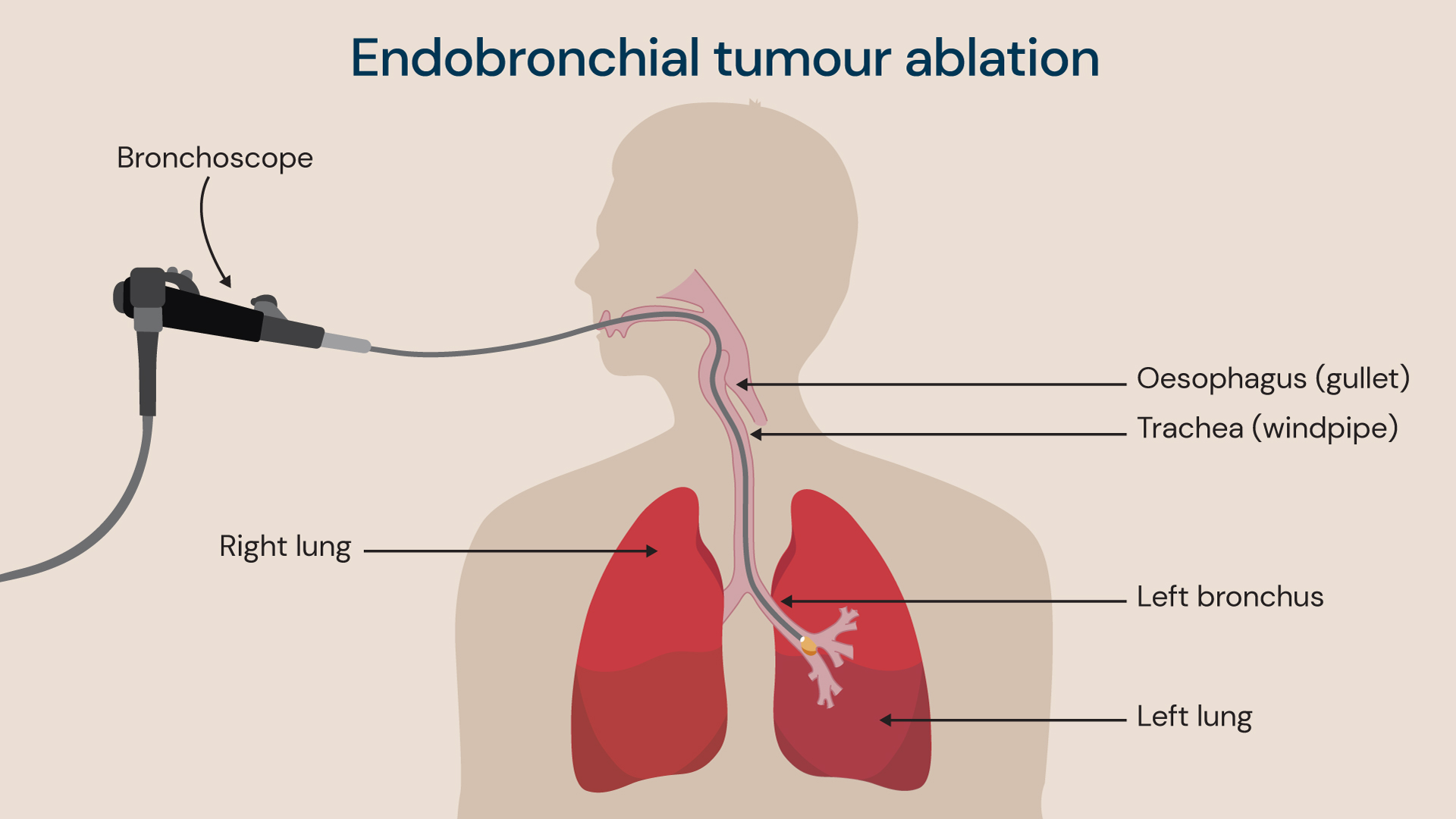 A visual of the endobronchial cryotherapy procedure. 