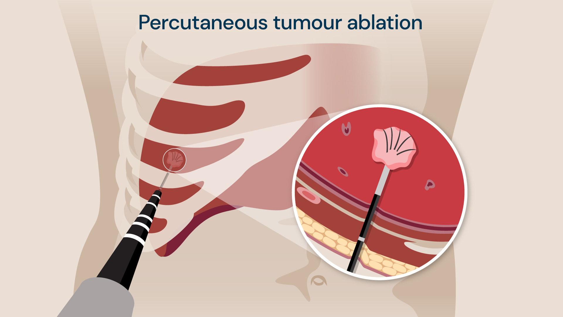 A visual of a percutaneous tumour ablation procedure.