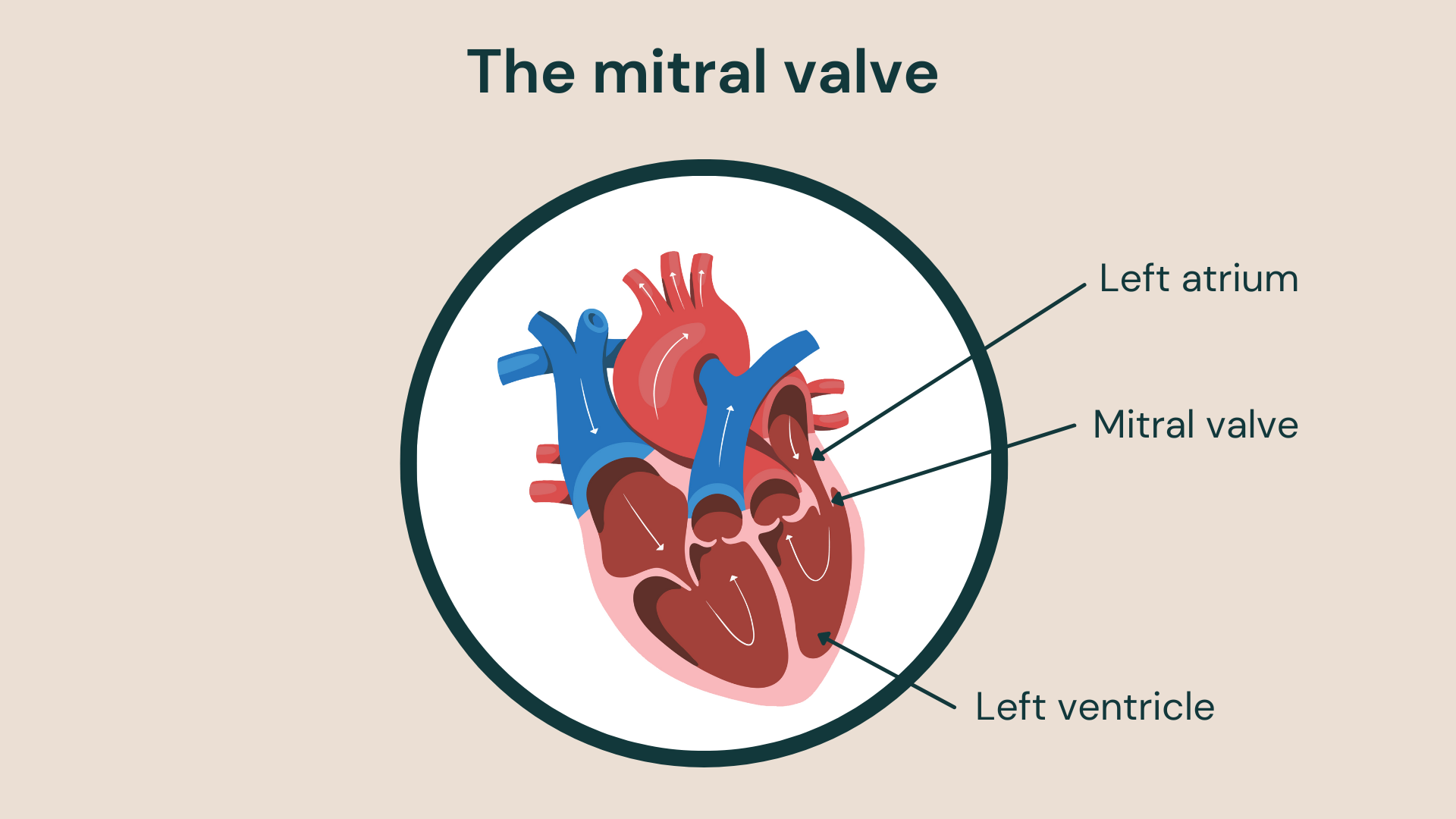 The mitral valve is one of the heart’s four valves.