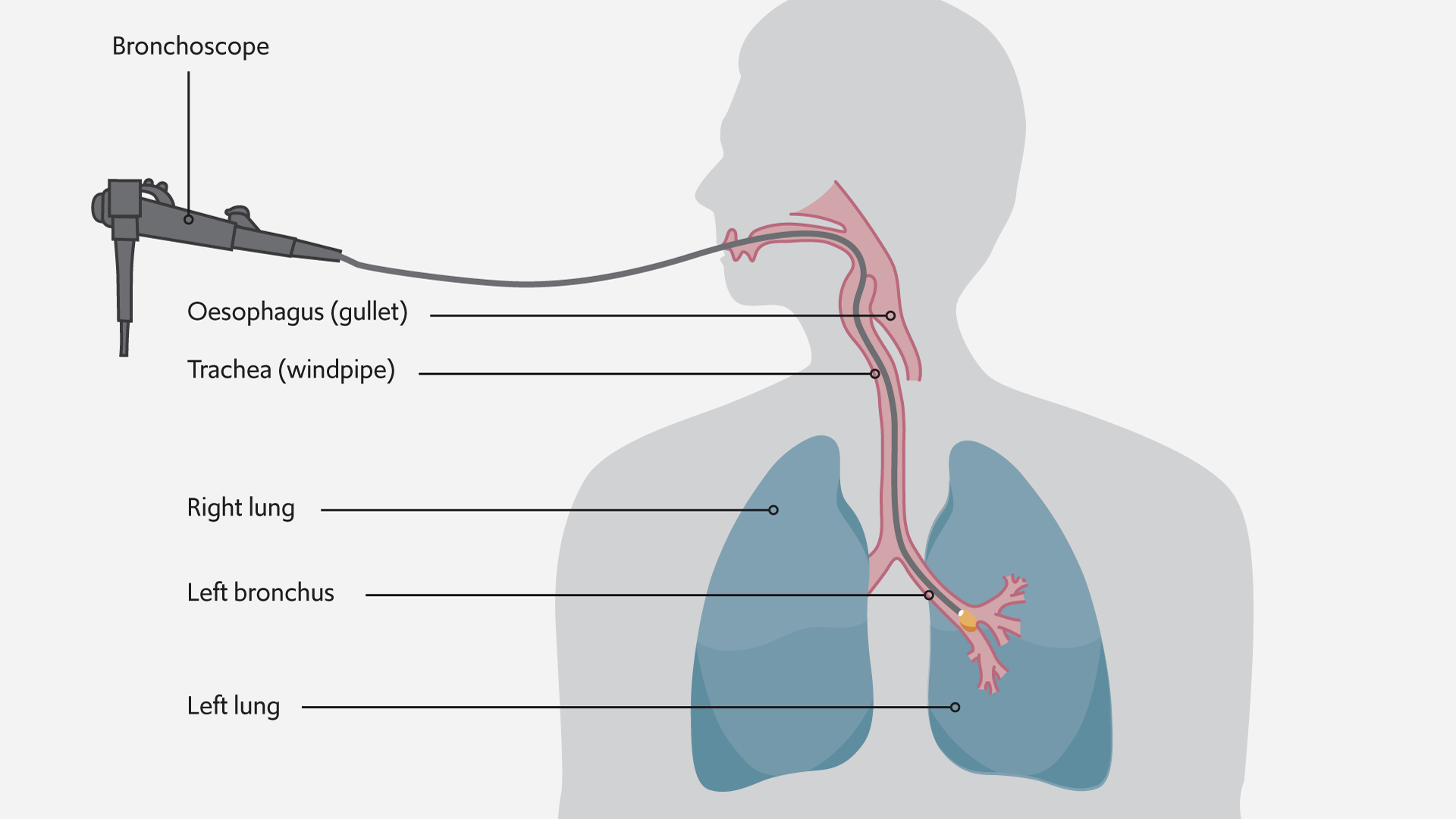 https://guysandstthomasspecialistcare.co.uk/app/uploads/2024/02/RBHH_Lung-cancer-cryotherapy_illustrations_1920x1080-01.png
