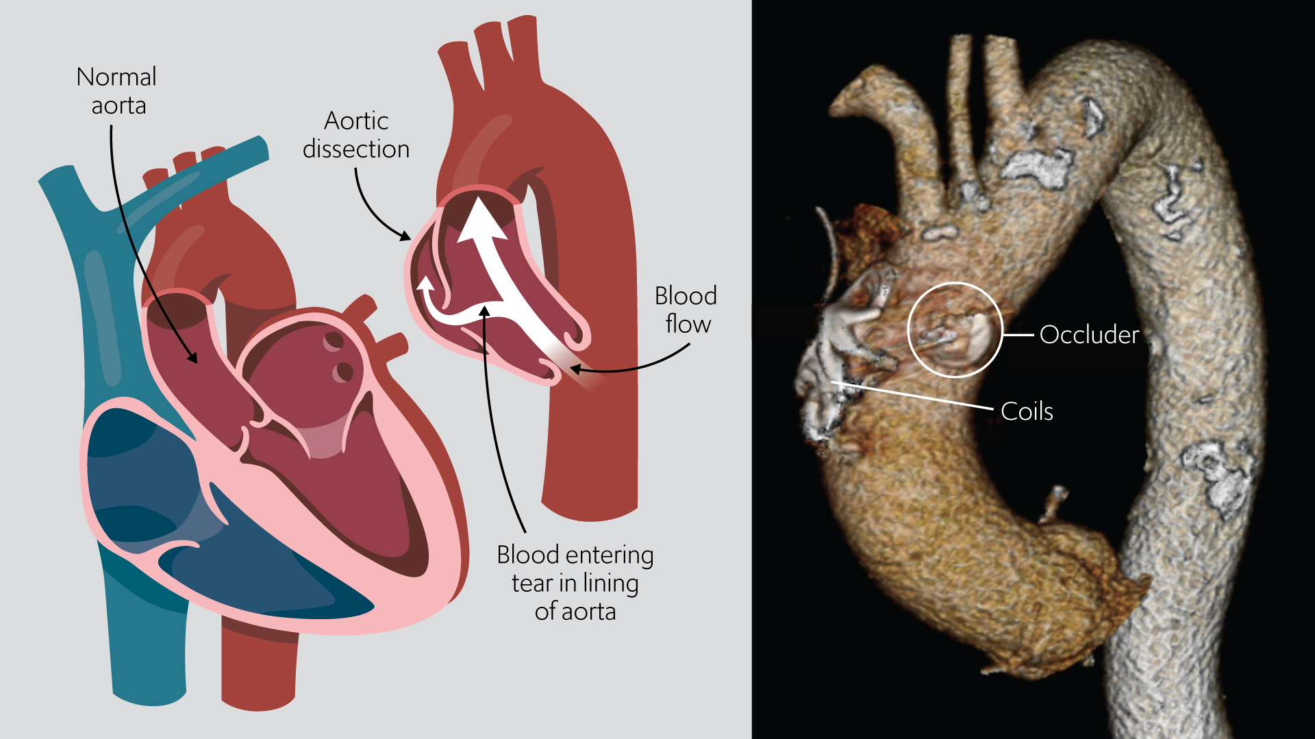 FLIRT heart procedure