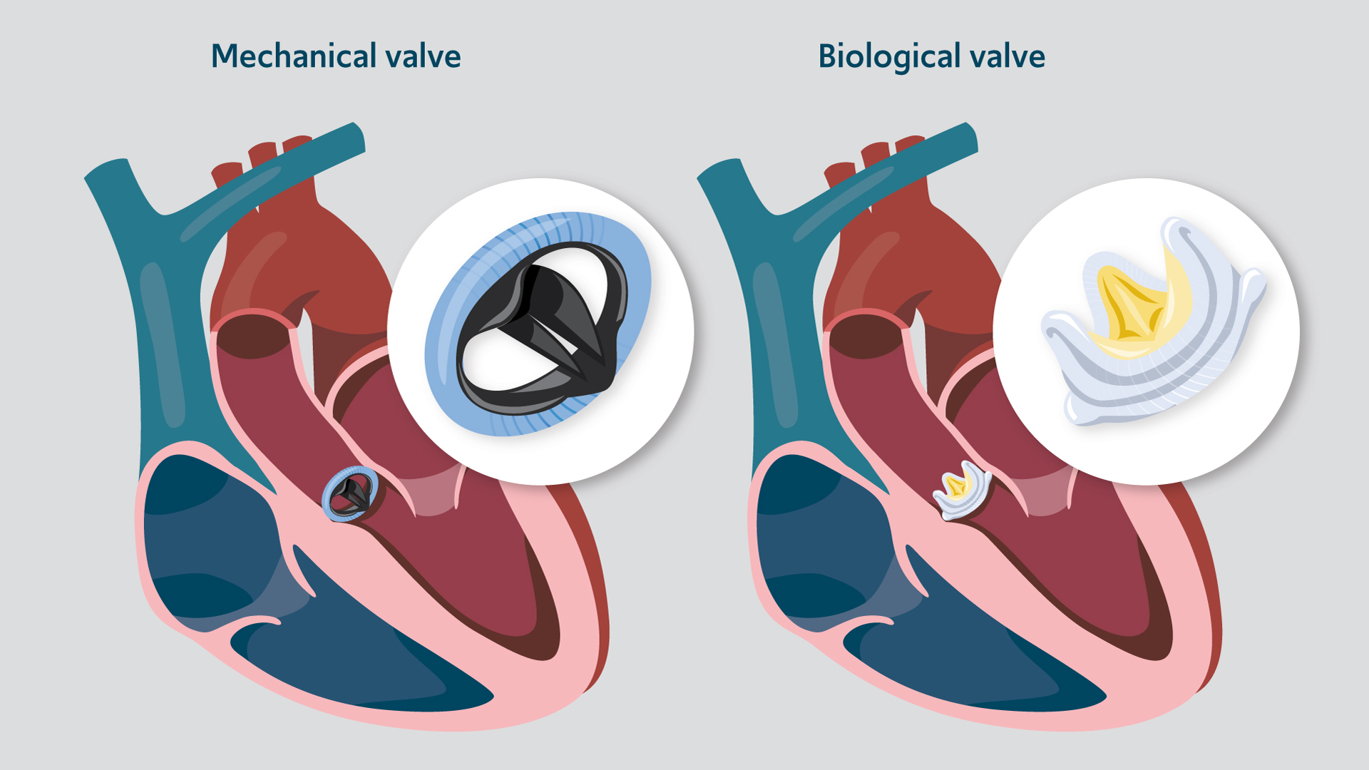 mechanical valve and biological valve in valve replacement surgery