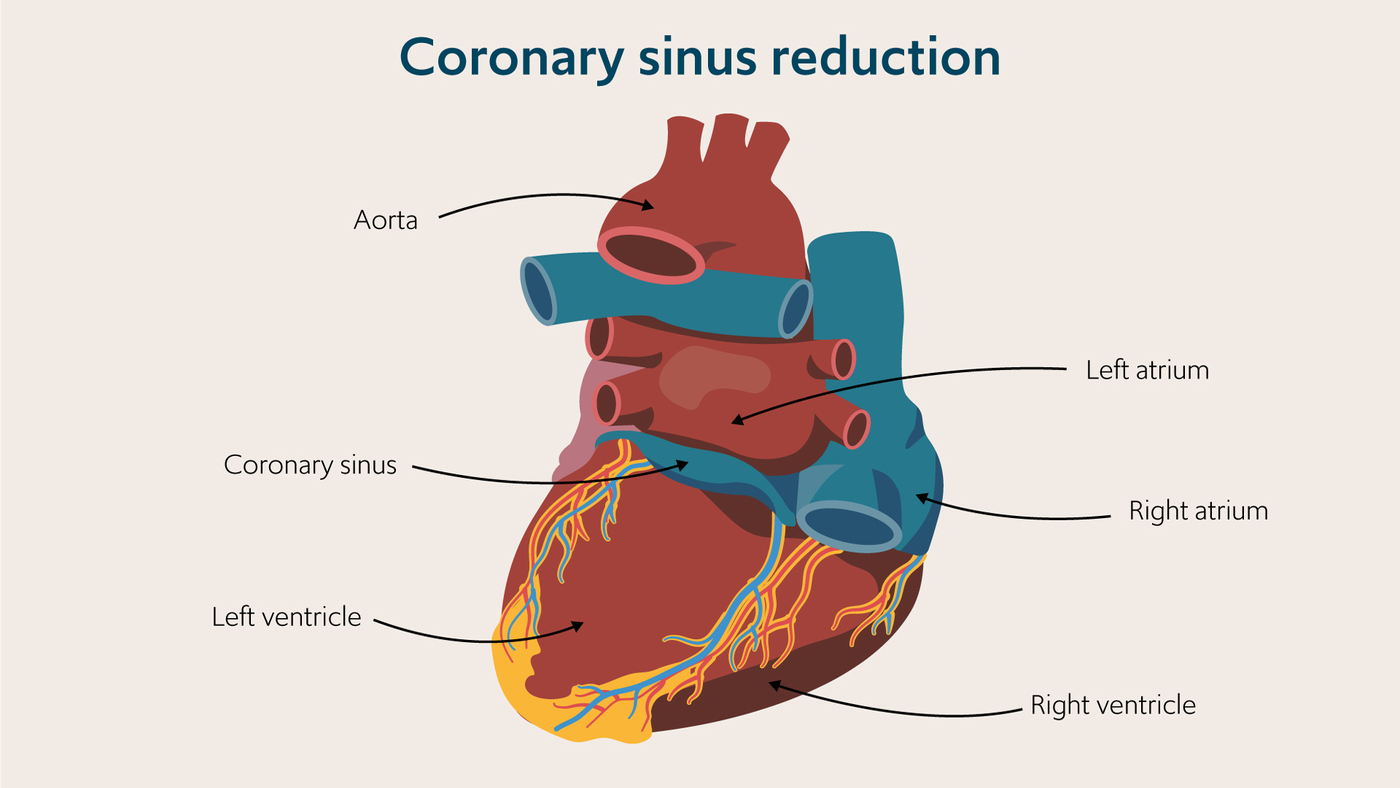 Coronary sinus reduction diagram