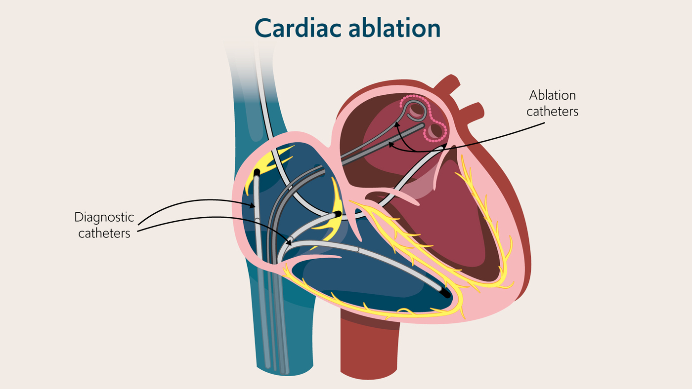 diagram of heart showing the placement of diagnosing and ablation cathetiers
