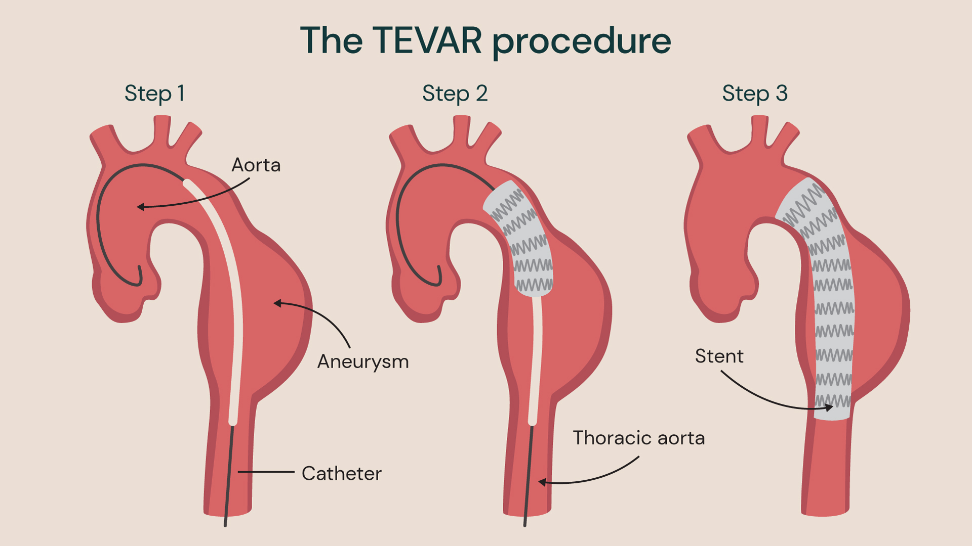TEVAR procedure