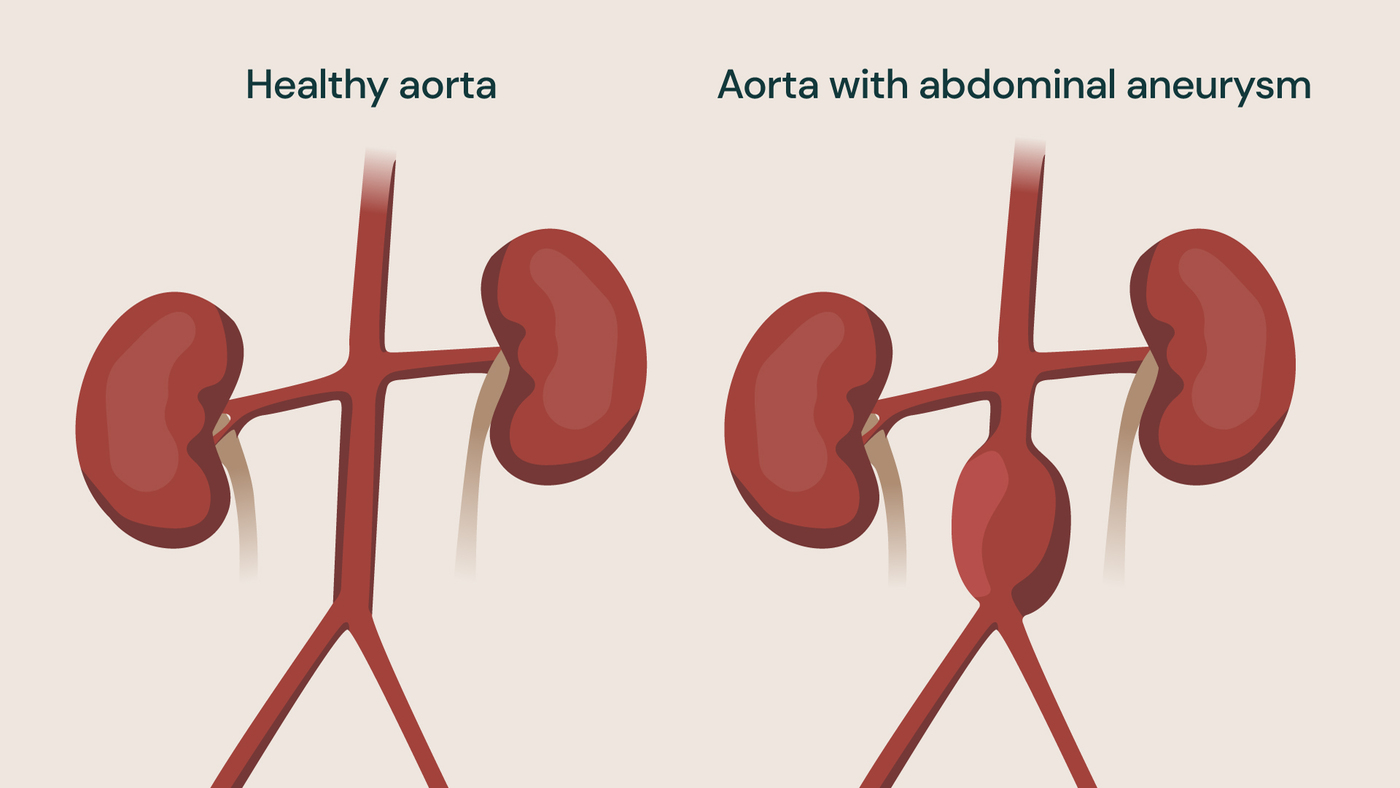 Diagram of aorta abdominal