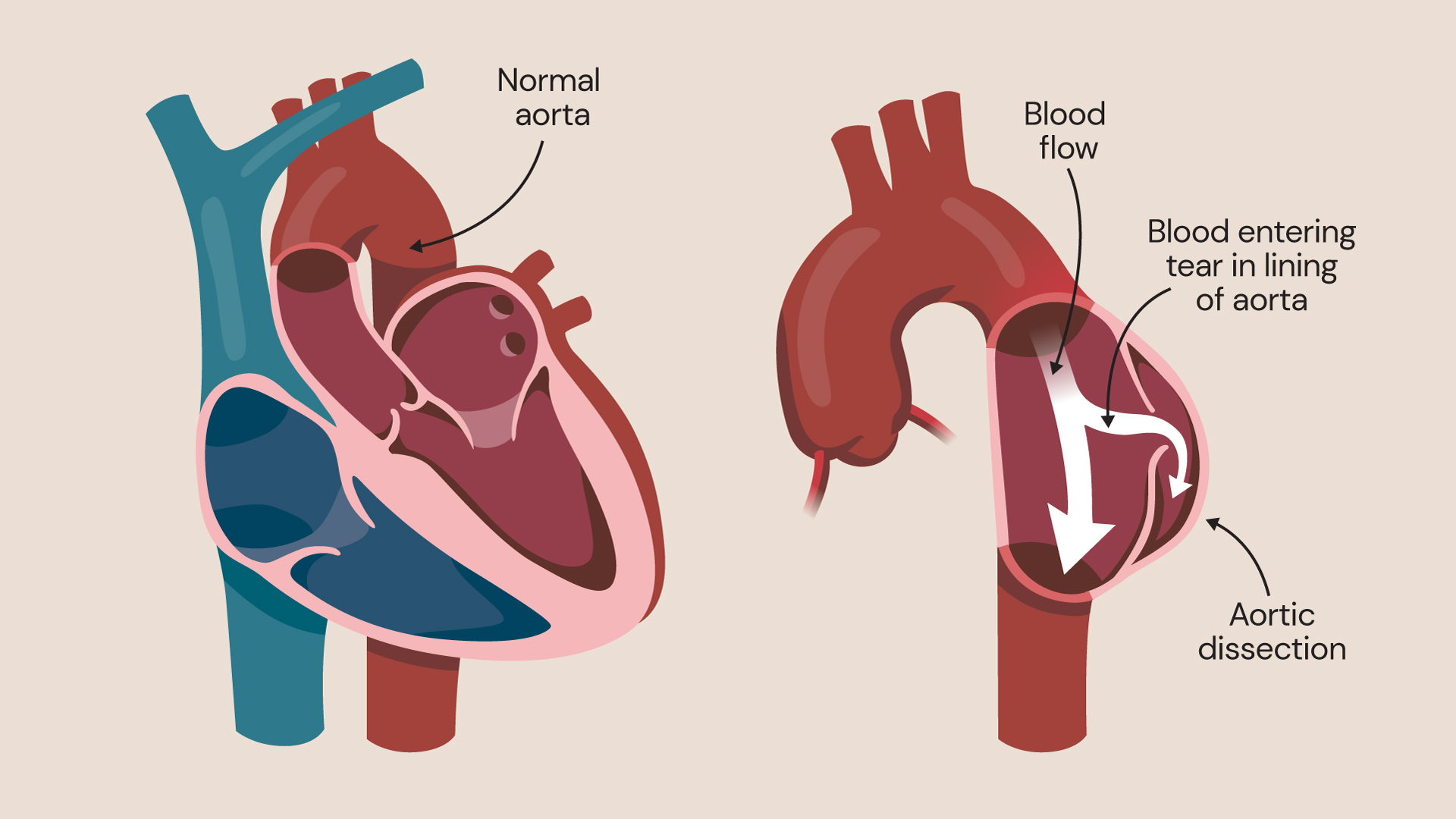 Healthy aorta vs aortic dissection