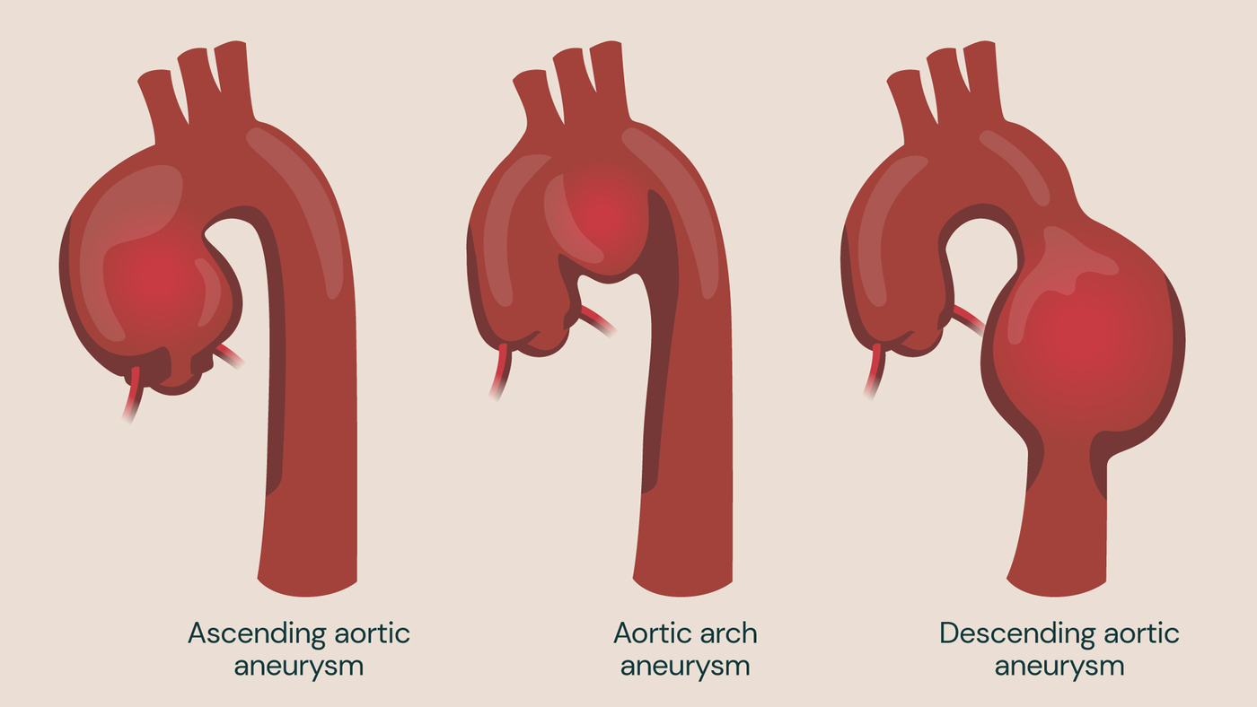 Diagram of aortic aneurysm