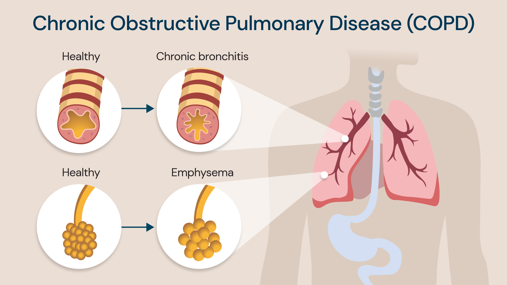 COPD chronic obstructive pulmonary disease