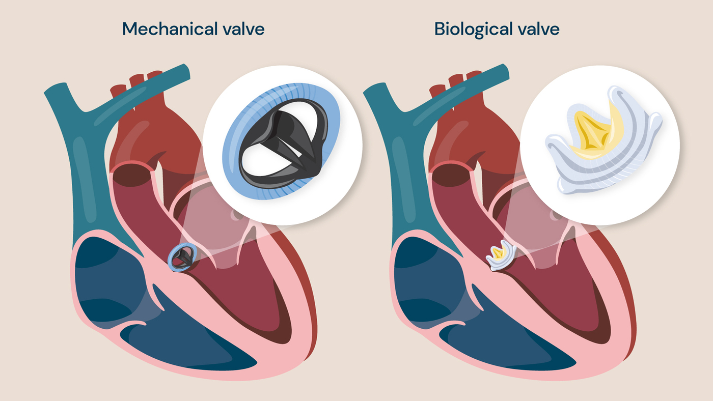 Illustration showing a mechanical valve and a biological valve.
