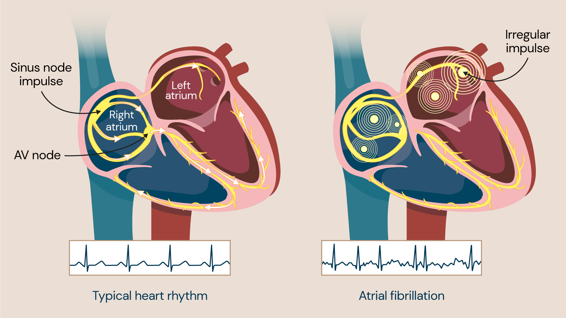 Atrial fibrillation occurs when the heart rhythm is irregular and either beats too fast or too slow. It is the most common arrhythmia.