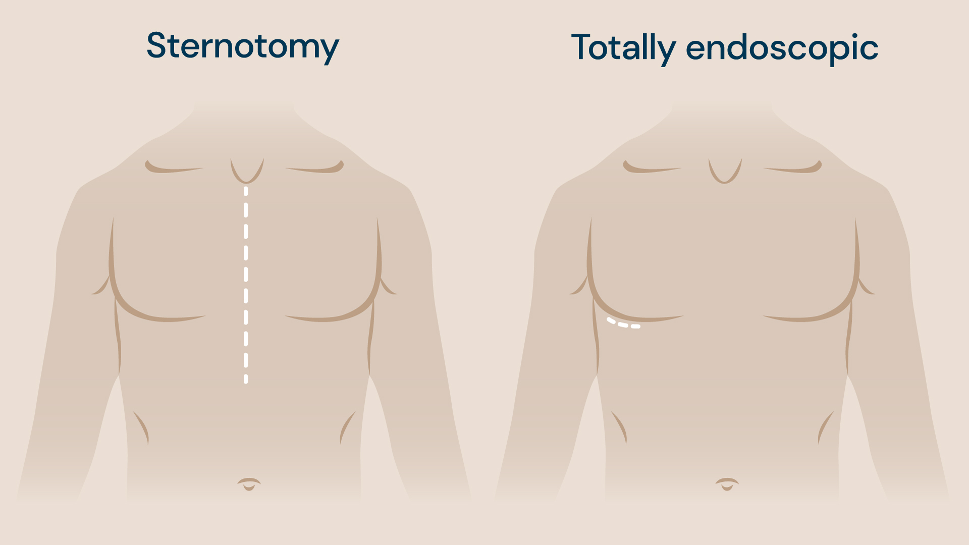 Totally endoscopic surgery vs sternotomy