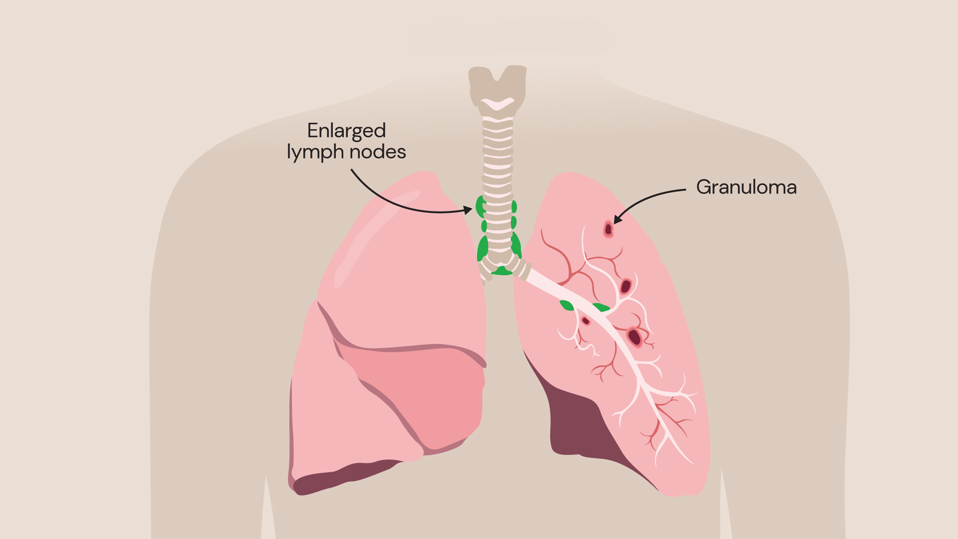 An illustration showing the effect of sarcoidosis on the lungs