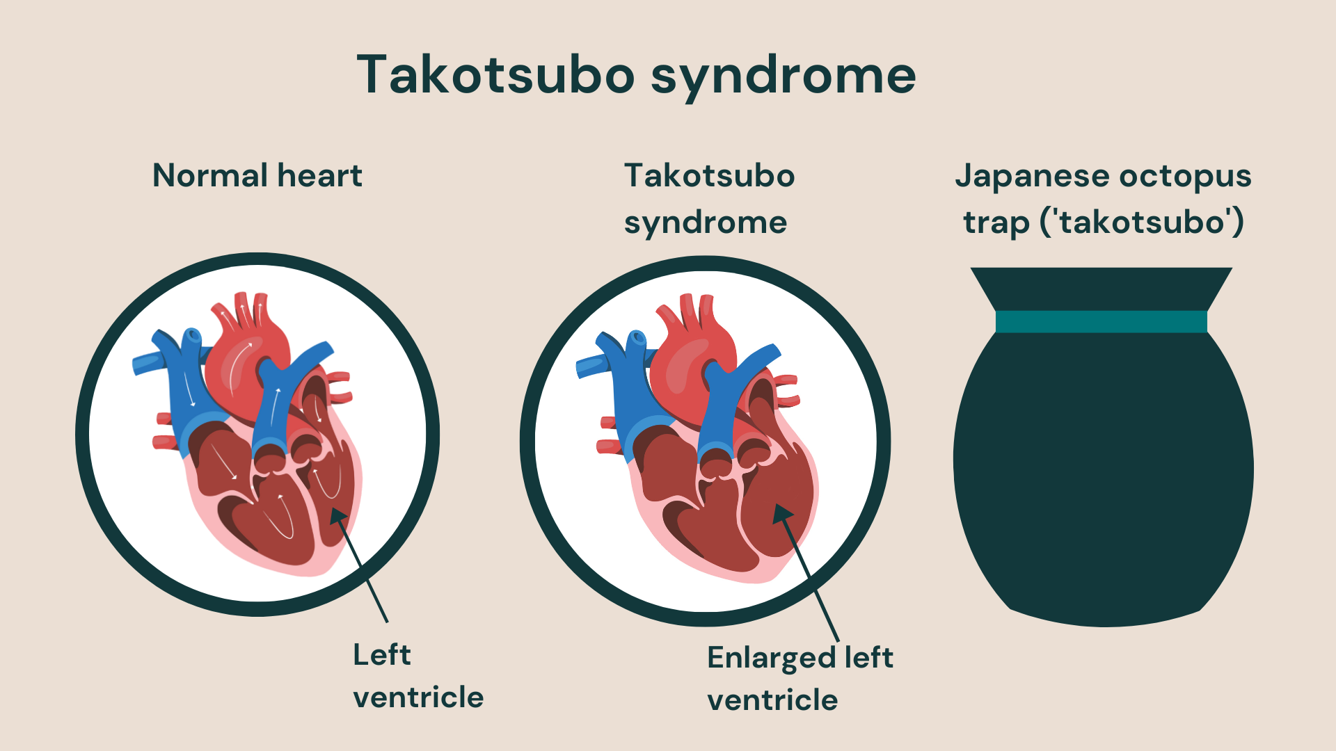 Takotsubo syndrome results in an englarged left heart ventricle