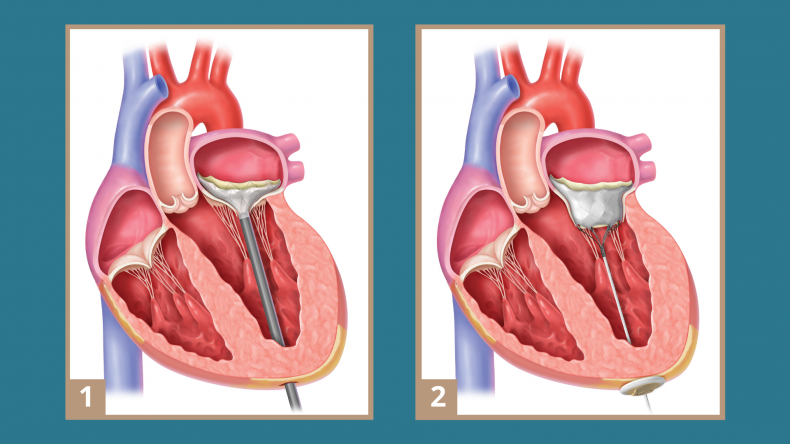 Tendyne TMVR is inserted into a patient's beating heart