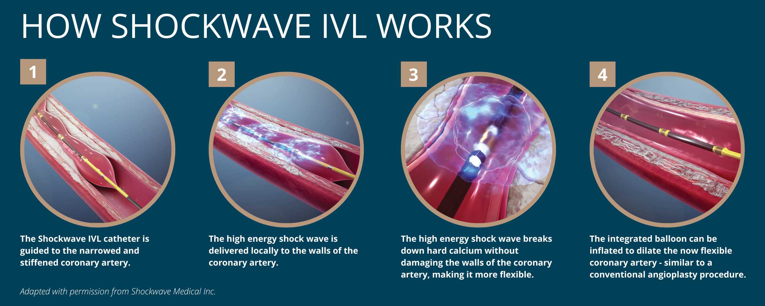 How shockwave IVL works