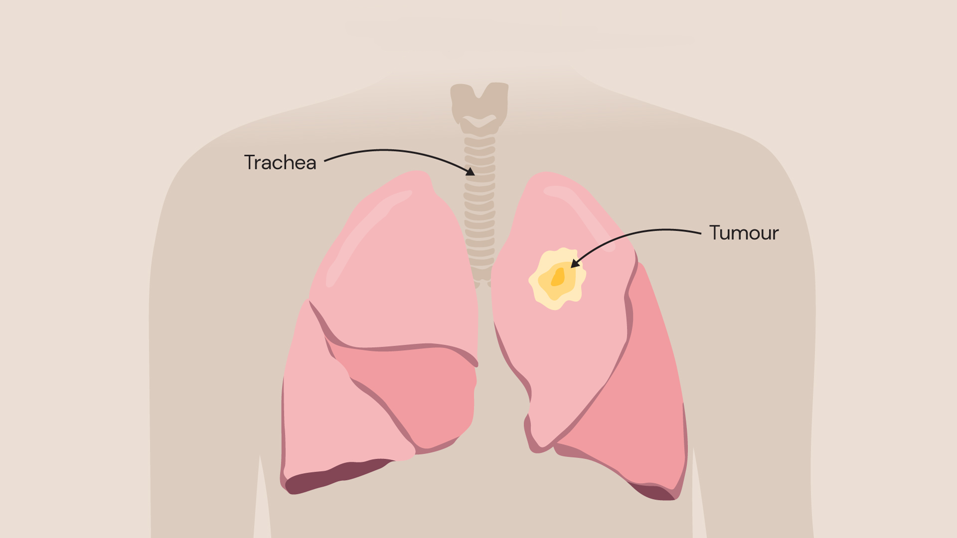An illustration showing lung cancer