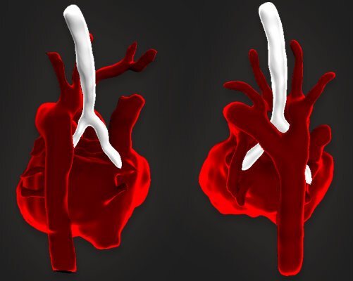A 3D MRI scan of a fetal heart