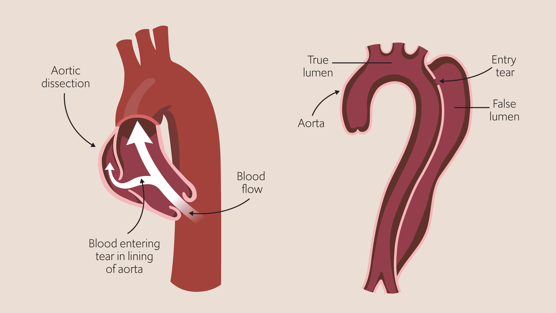 Aortic dissection and the false lumen