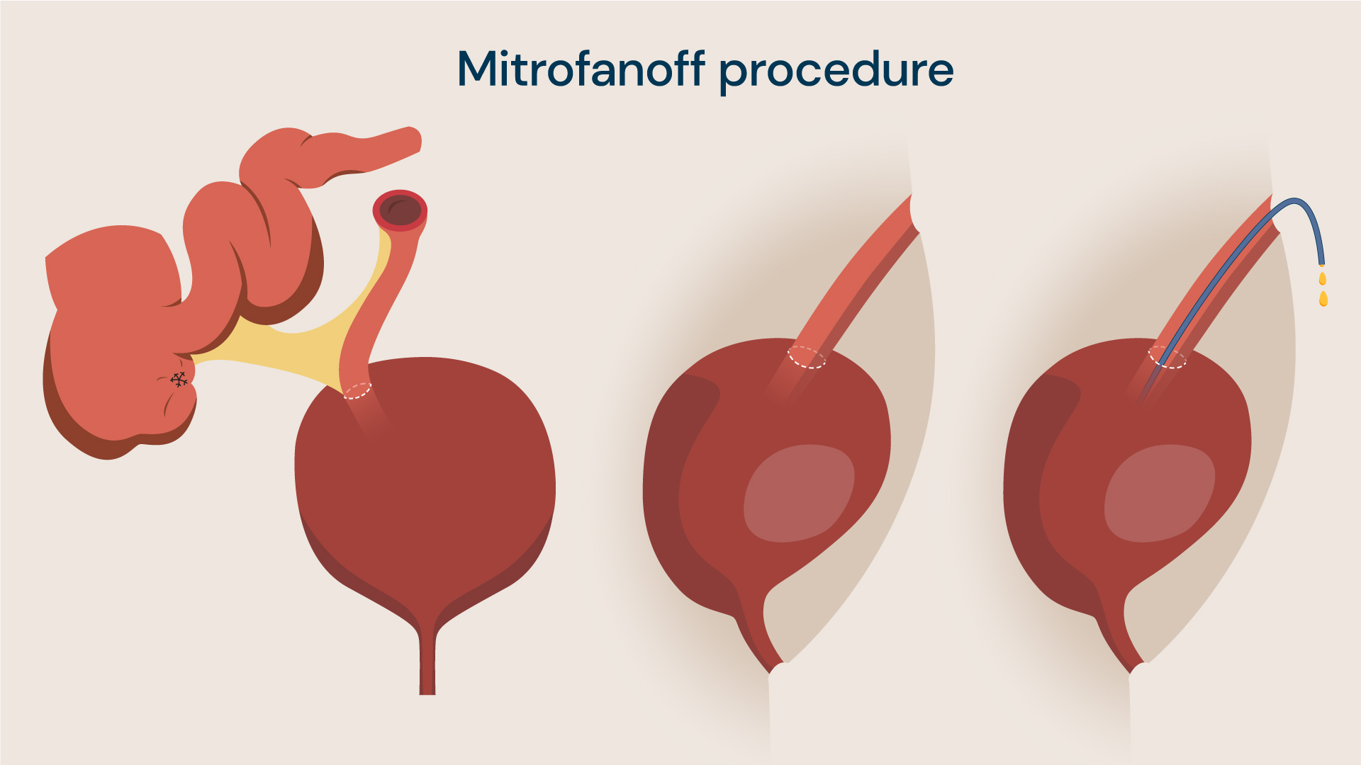 Mitrofanoff procedure treats children who struggle to drain their bladders in the normal way
