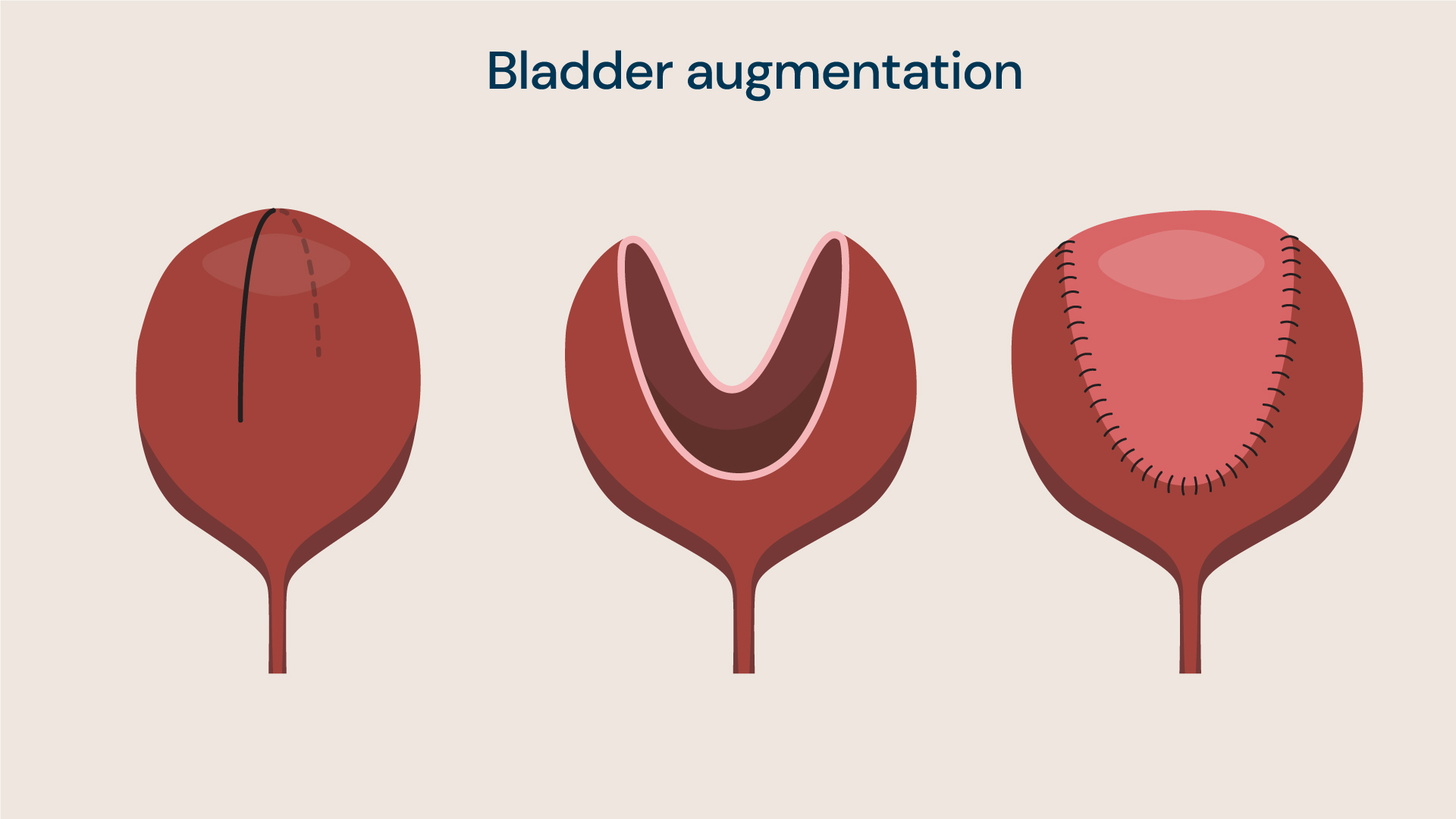 Bladder augmentation is a procedure to treat patients with a small bladder leading to high bladder pressure