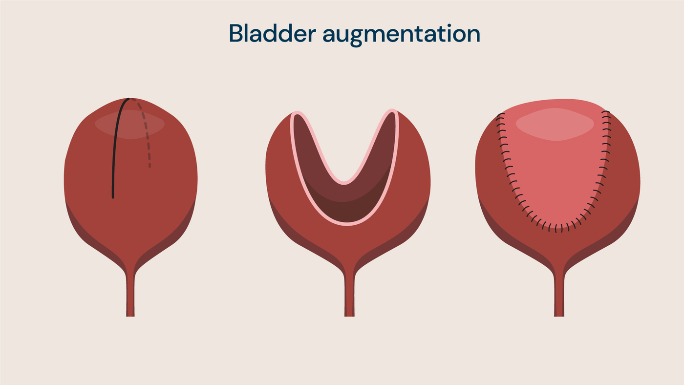 The bladder (left) is opened up during the procedure (middle) and a piece of bowel tissue is stitched onto the bladder to increase its size and capacity (right).