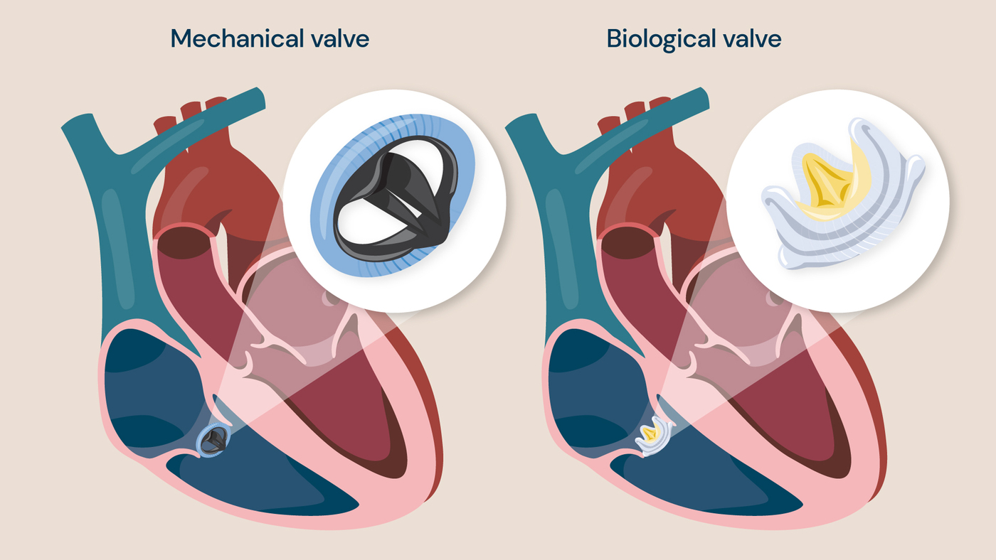 An illustration showing mechanical and biological replacement valves.
