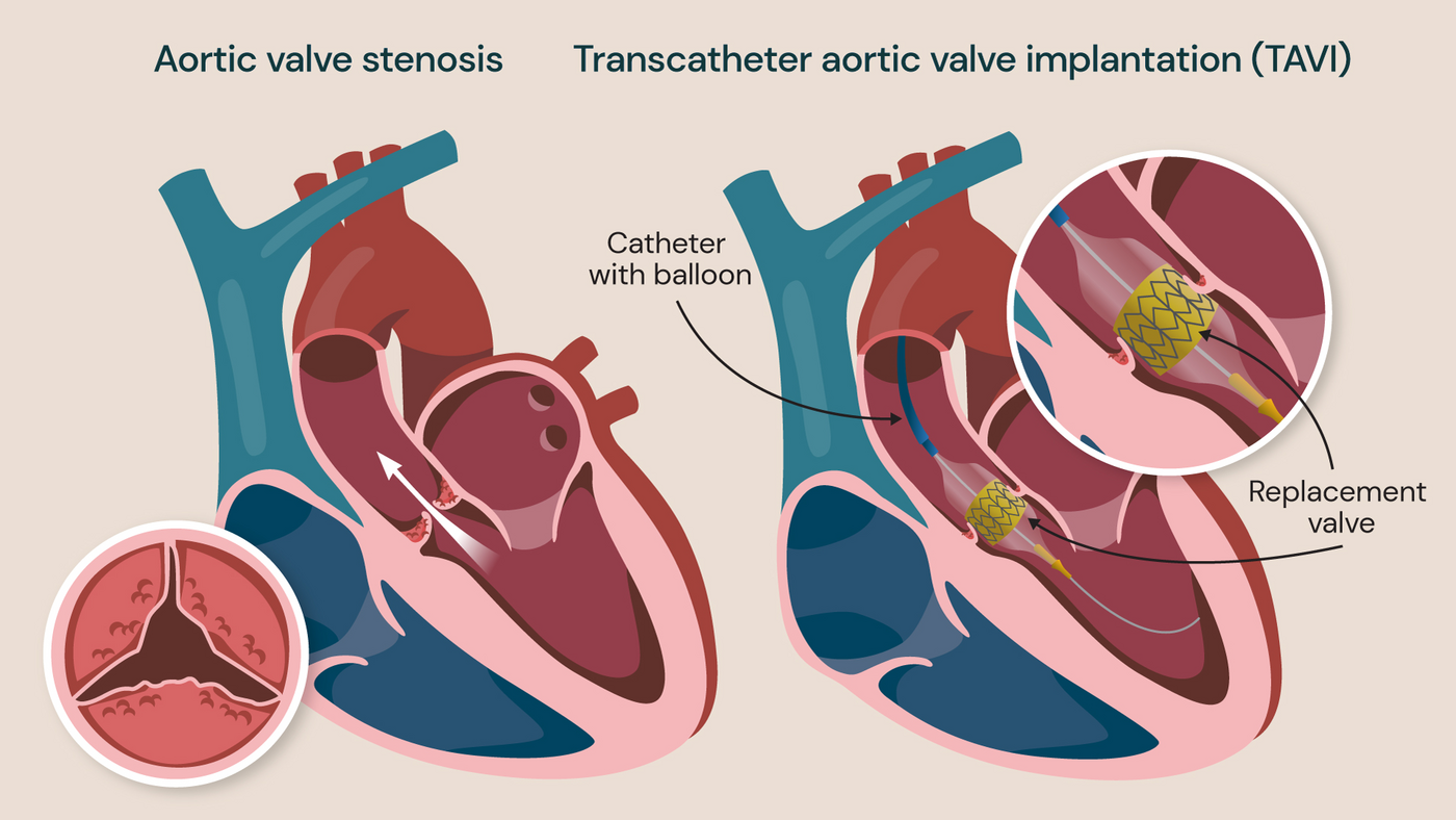 An illustration showing the TAVI procedure