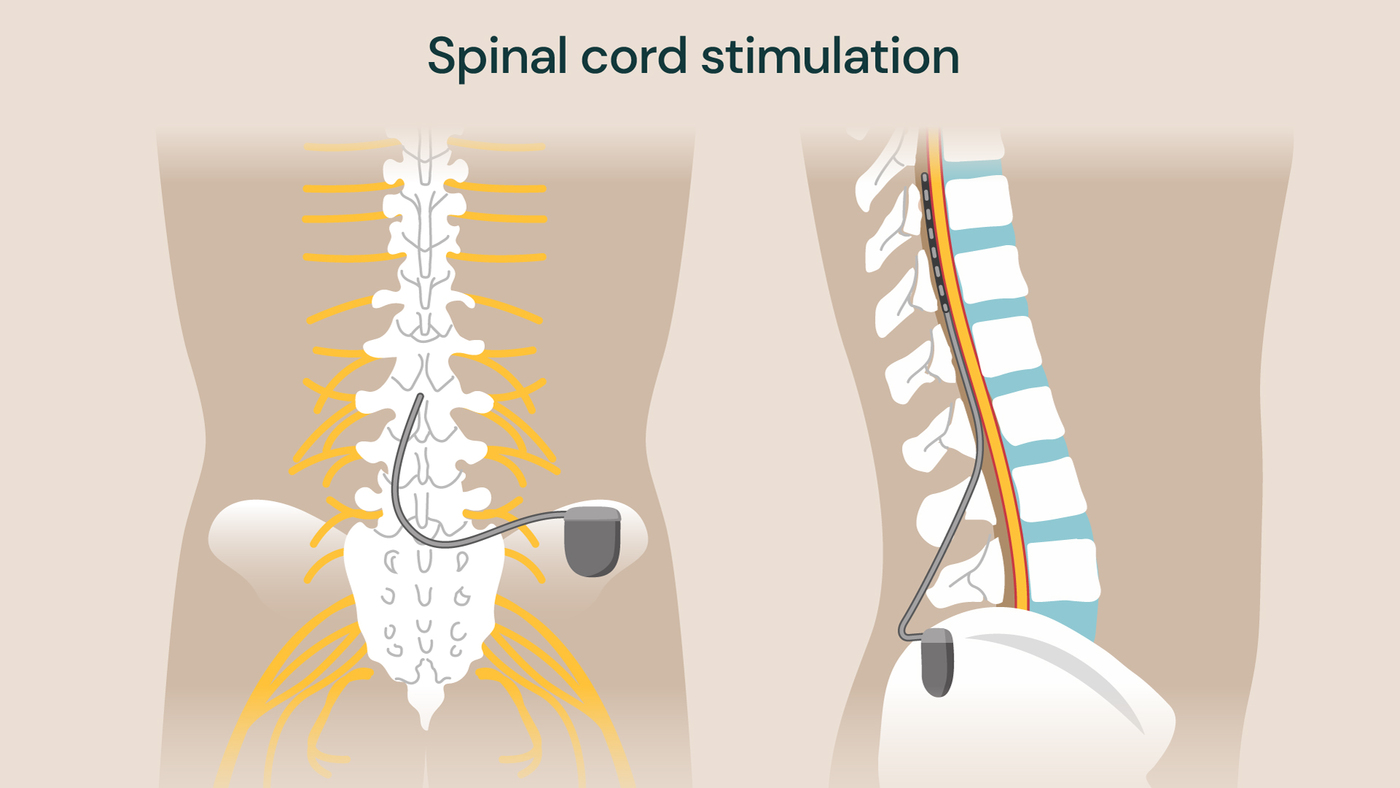 Spinal cord stimulation shown with the implanted electrodes attached to the spine, and the generator device at the base of the spine