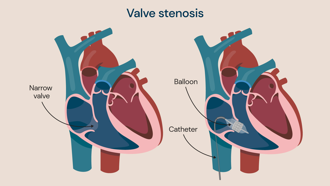 A diagram of a balloon valvuloplasty procedure to treat valve stenosis.