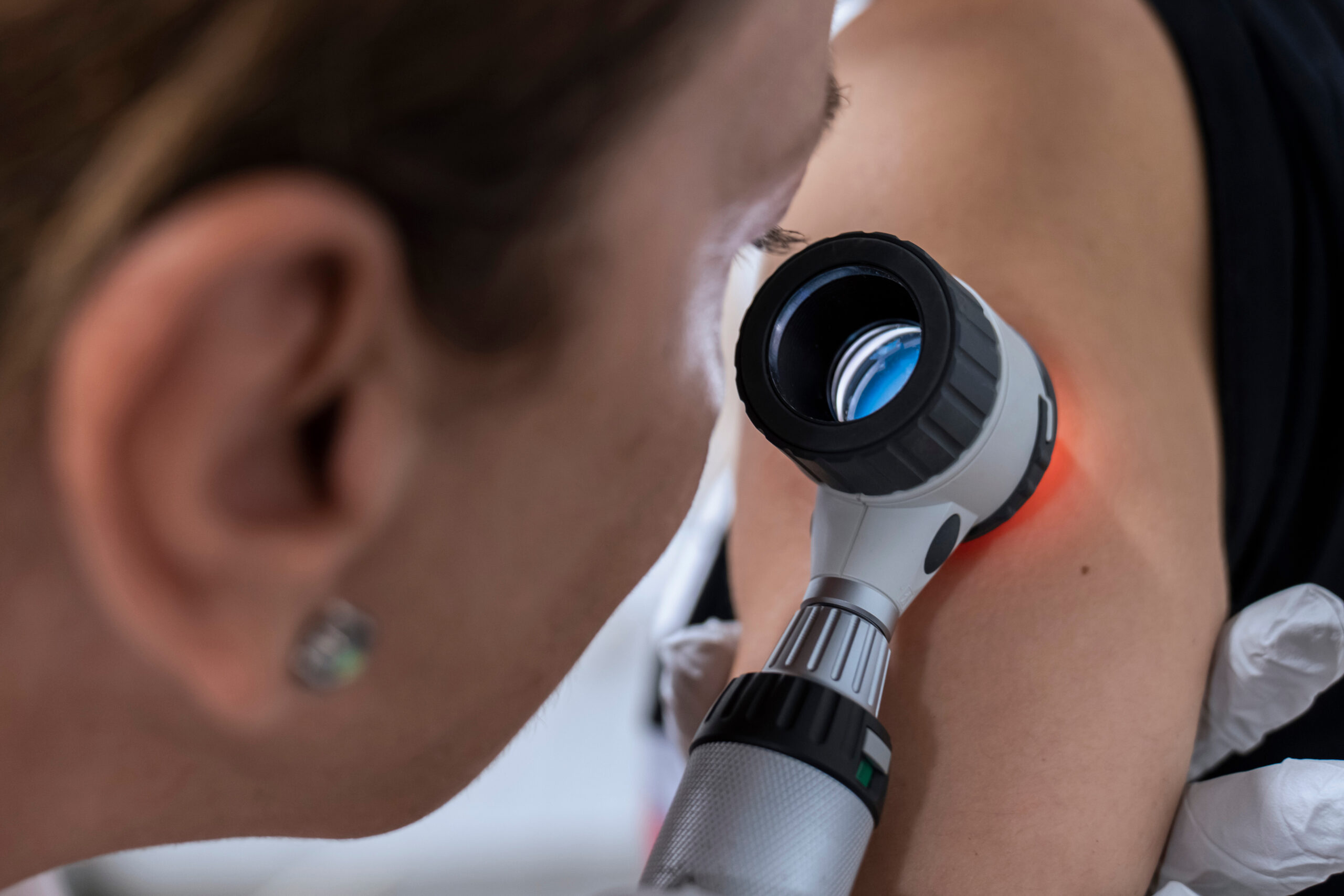 Dermatologist examines birthmarks on the patient's skin with a dermatoscope.