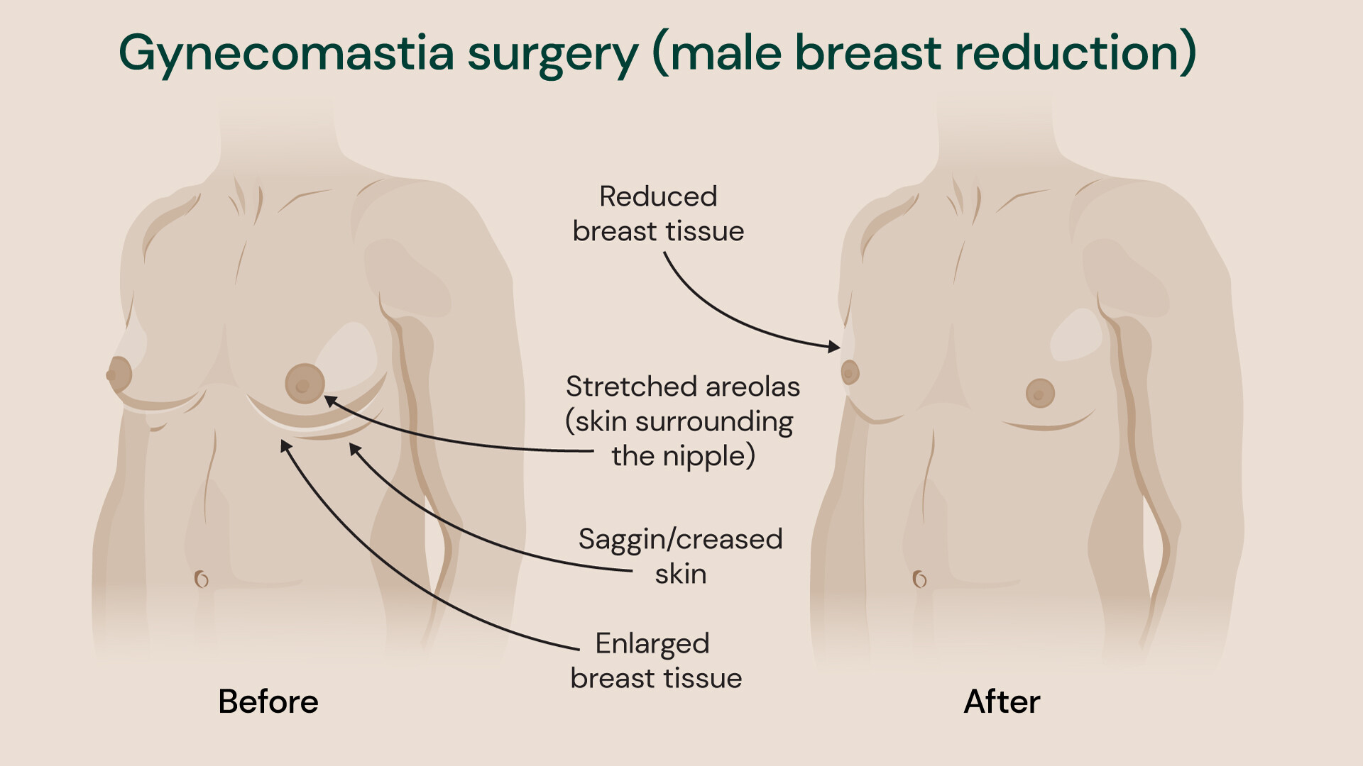 Gynaecomastia surgery