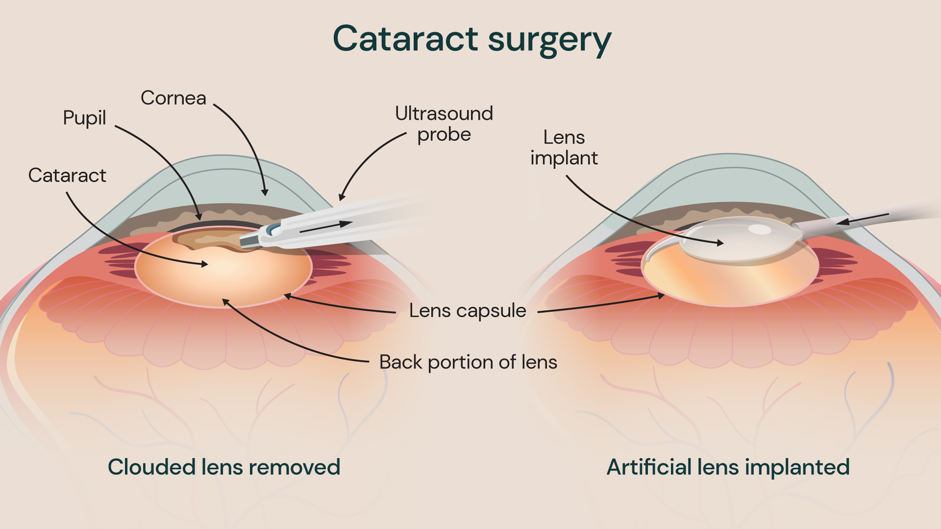 Illustration showing how cataracts are treated using surgery