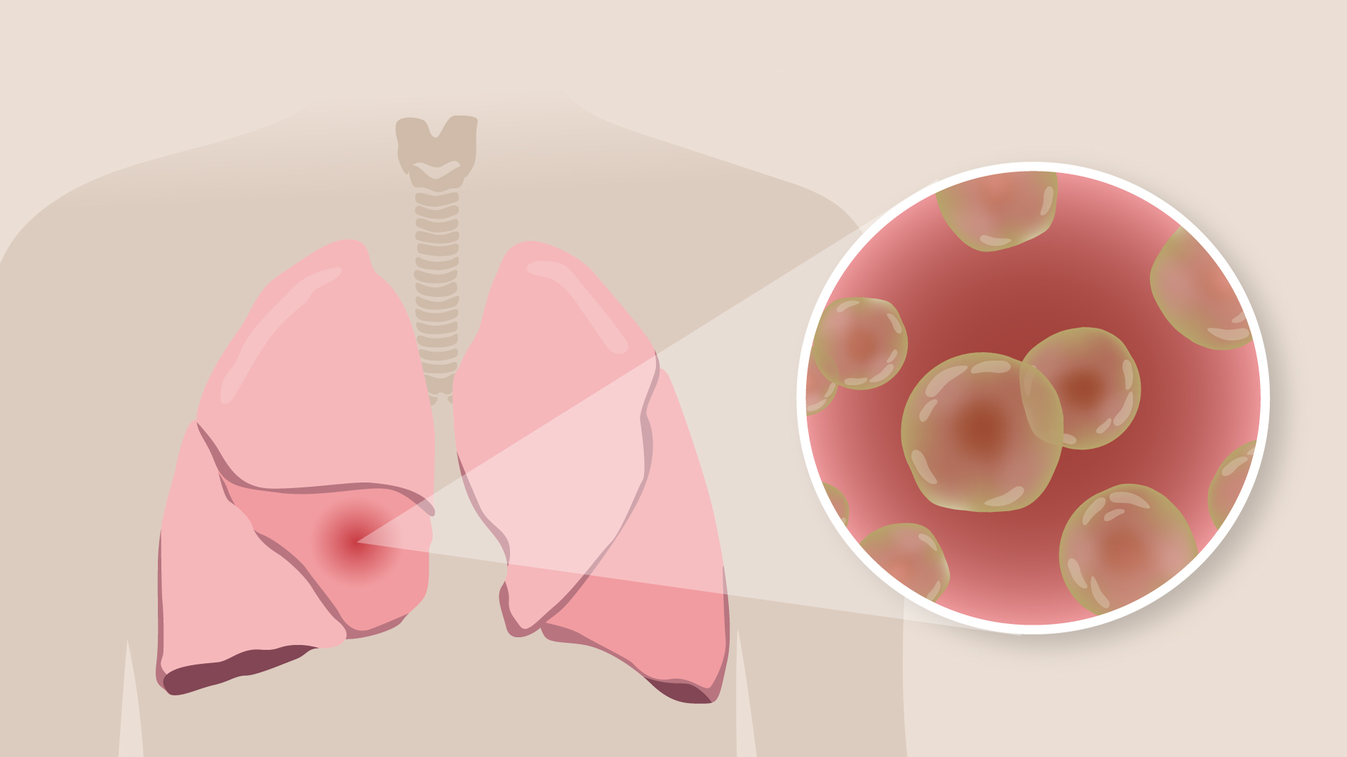 An illustration showing where infections occur in the lungs