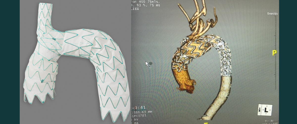 The NexusTM Stent Graft System (left) transforms a complex open-heart surgery to repair an aortic arch aneurysm into a standard keyhole procedure. The multi-part stent is customised to fit each individual patient optimally and is the first branched stent system to treat disease of the aortic arch. A 3D CT scan (right) shows the stent placed in the patient’s aortic arch.