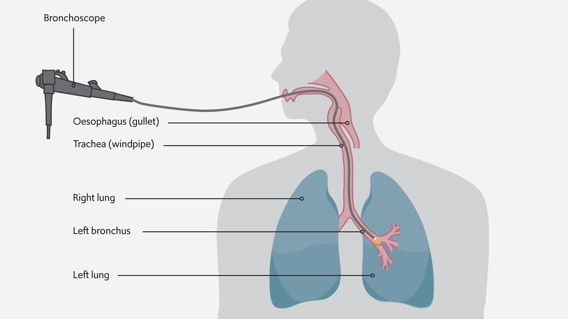 Lung cancer cryotherapy