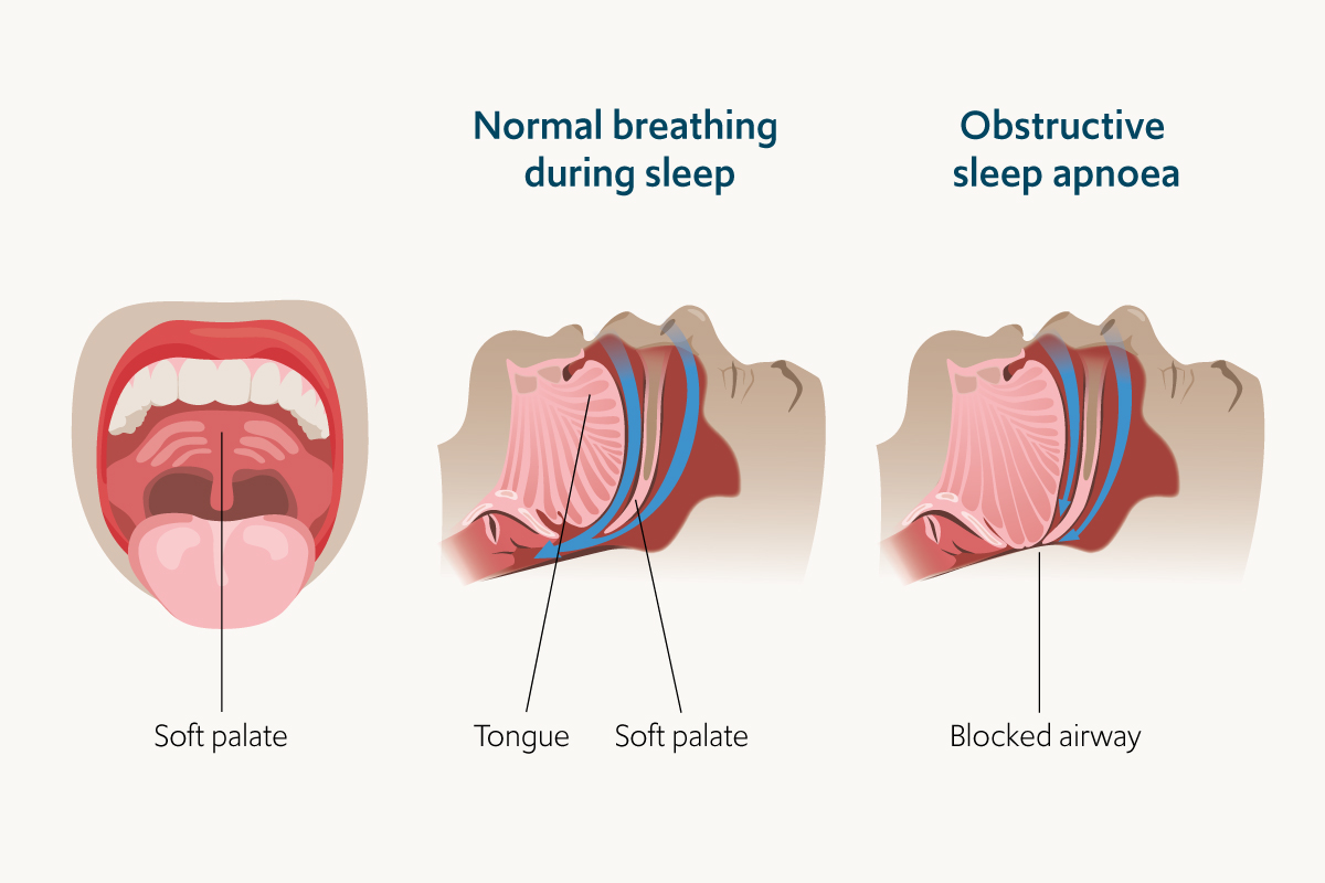 Sleep apnoea