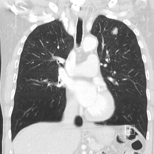 Keyhole surgical treatments for complex lung cancers