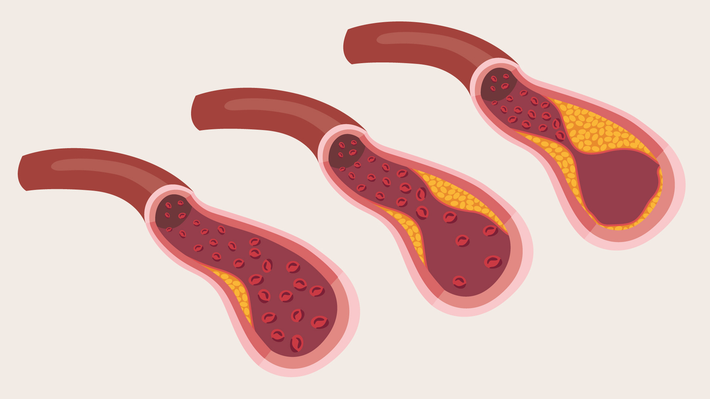 An illustration showing how coronary heart disease is cause by a build up of plaque in the arteries