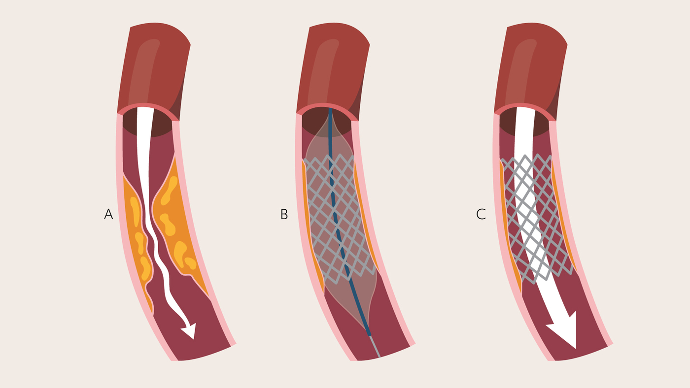 Coronary Artery Stent Coronary Artery Stent