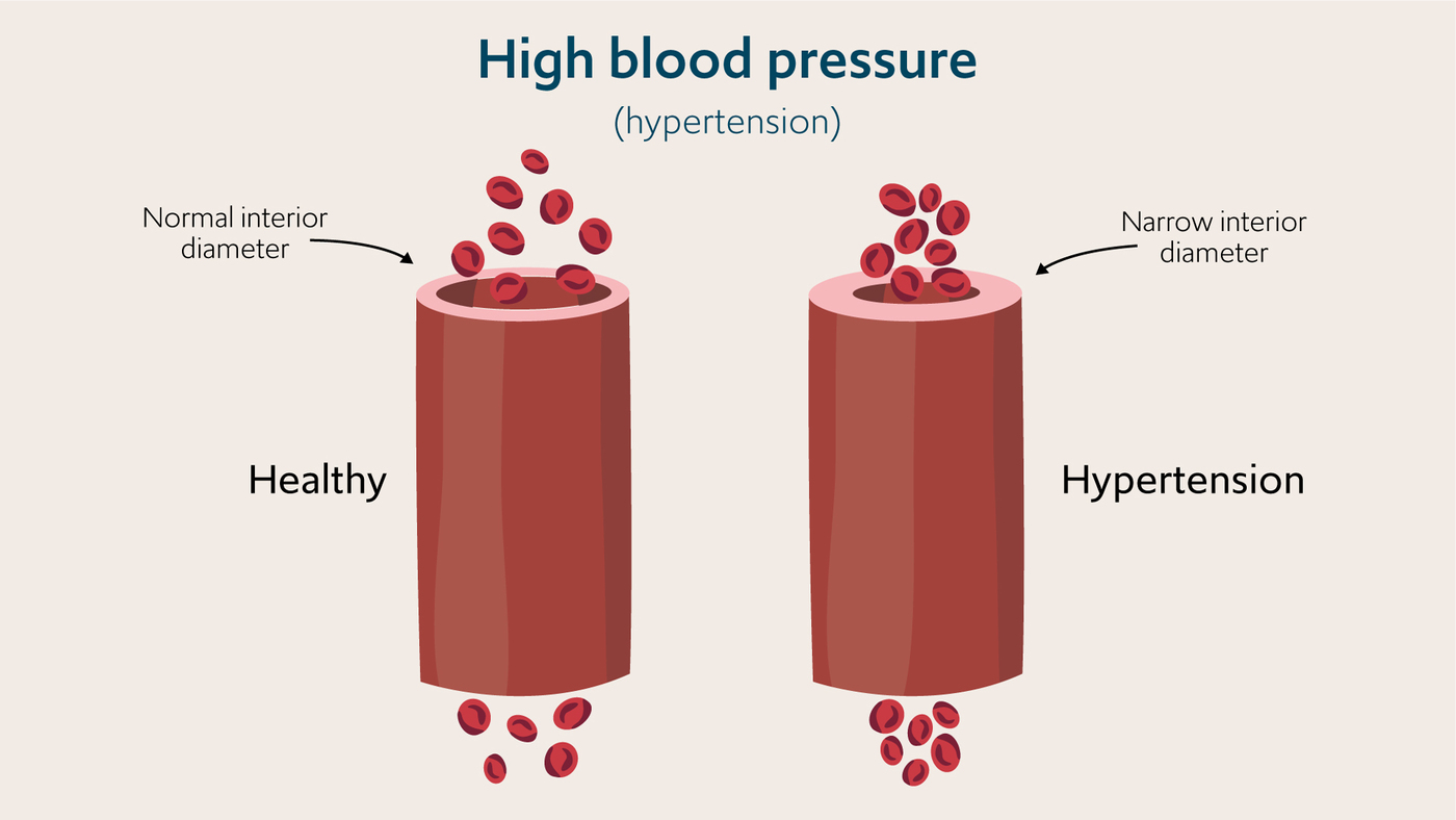 An illustration showing how high blood pressure occurs
