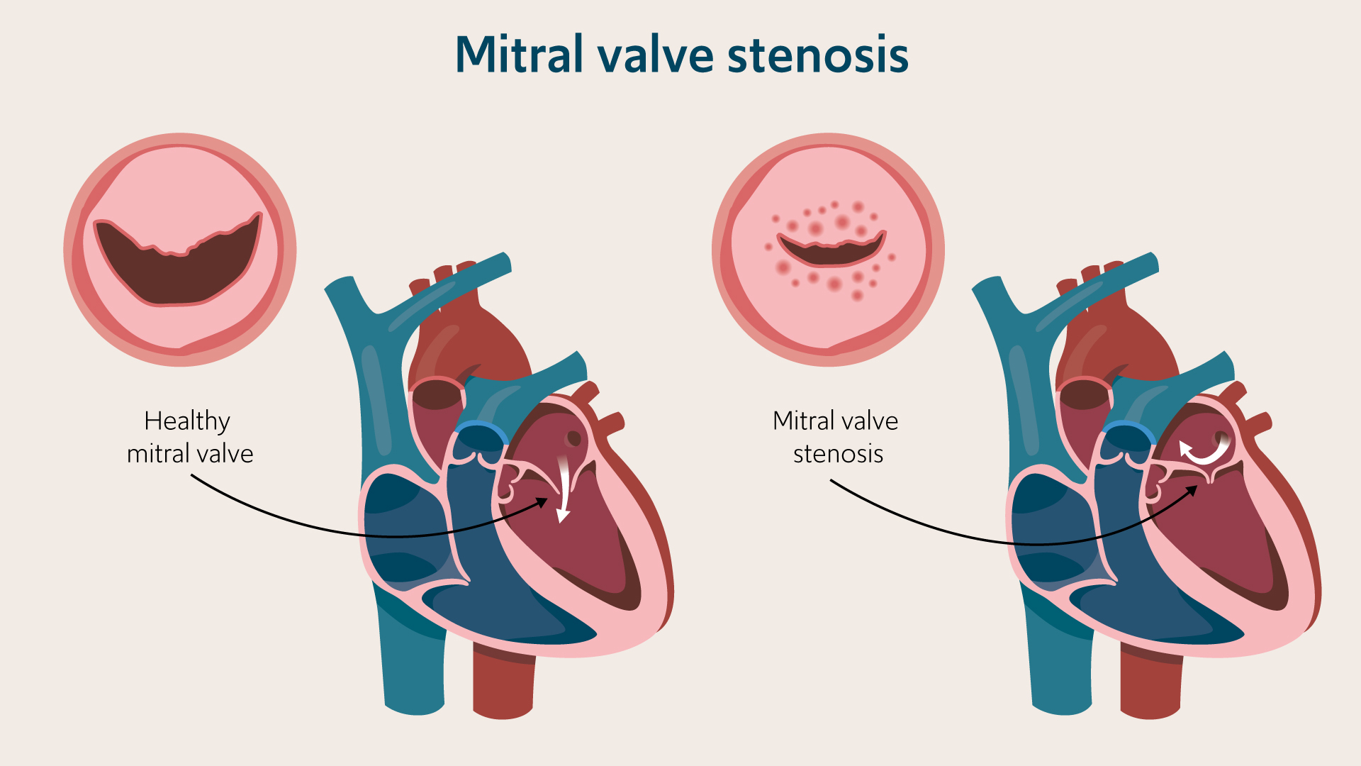 Mitral valve stenosis