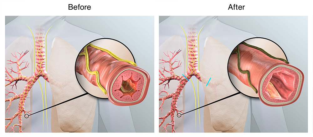 before and after targeted lung denervation with Nuvaira