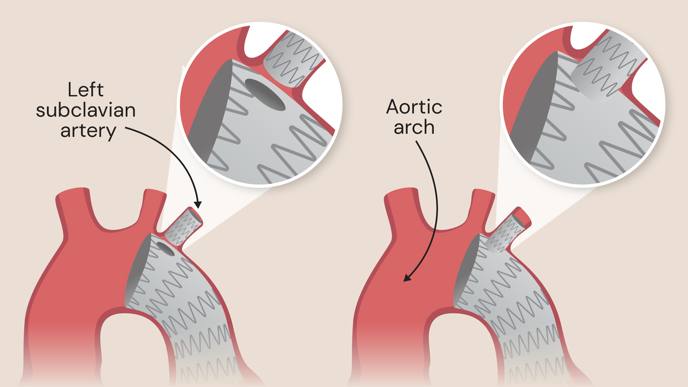 Unibody TEVAR procedure