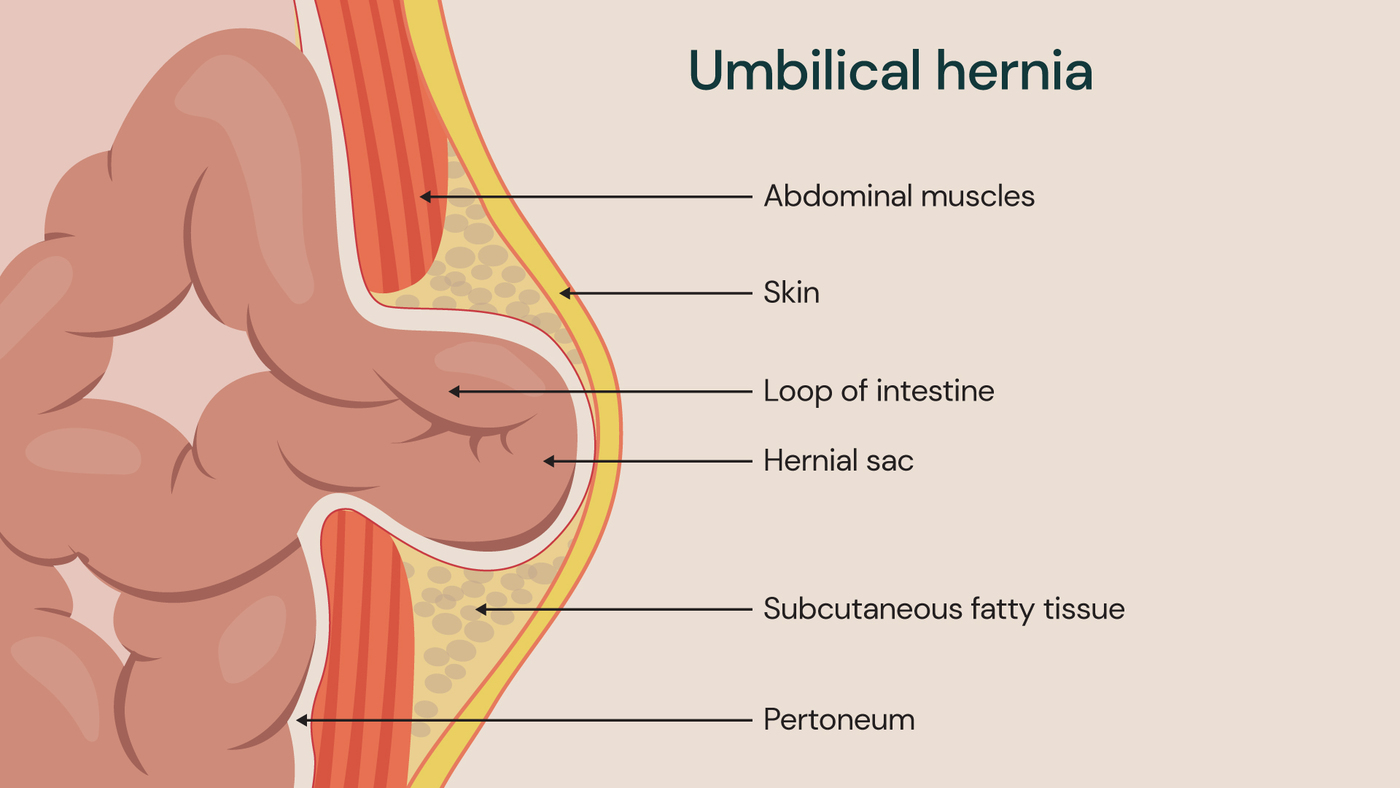 Umbilical hernia